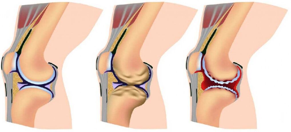 Les articulations et l'arthrose saines affectées