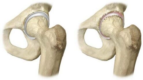 articulation de la hanche saine affectée par l'arthrose